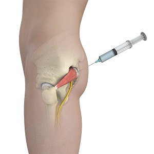 Piriformis Muscle Injections