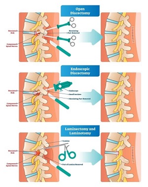 Spinal Cord and Nerve Decompression