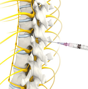 Nonsurgical Spine Treatments