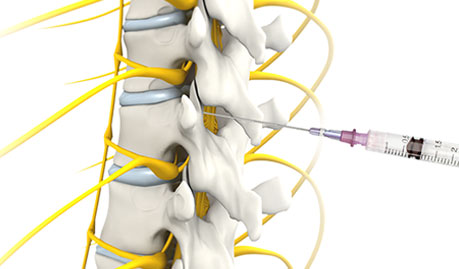 Nonsurgical Spine Treatments