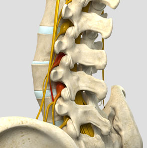Spinal Cord & Nerve Decompression